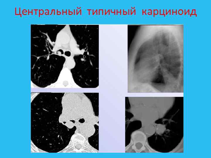 Центральный типичный карциноид 