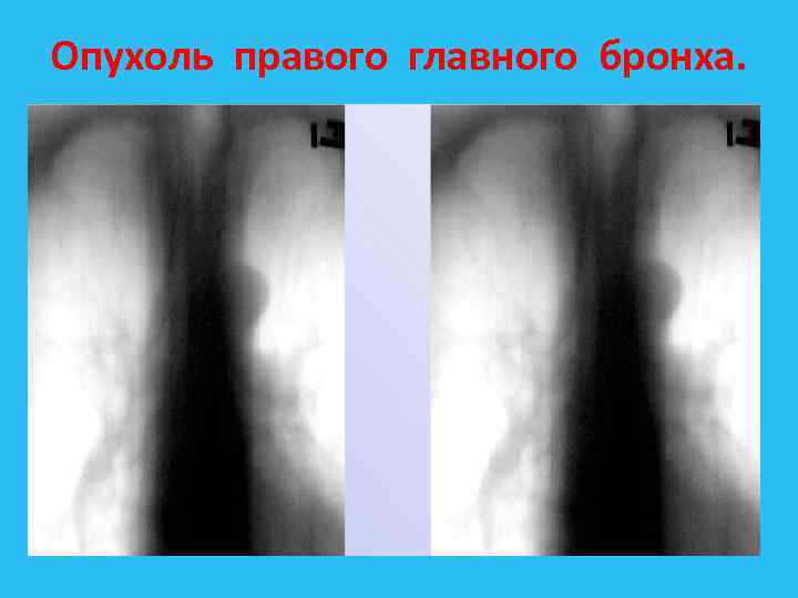 Опухоль правого главного бронха. 