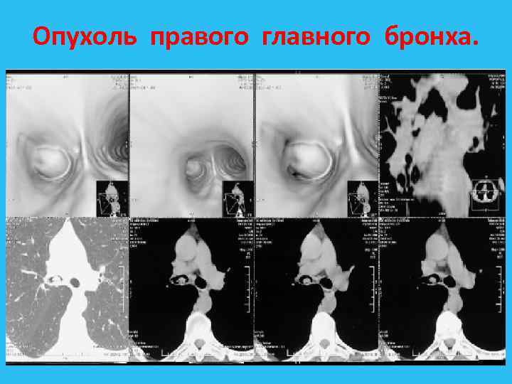 Опухоль правого главного бронха. 