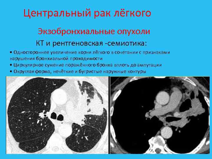 Центральный рак лёгкого Экзобронхиальные опухоли КТ и рентгеновская семиотика: • Одностороннее увеличение корня лёгкого