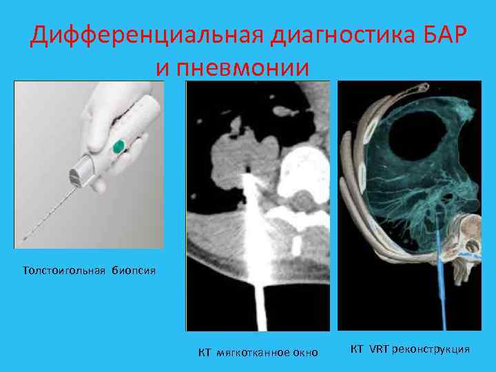 Дифференциальная диагностика БАР и пневмонии Толстоигольная биопсия КТ мягкотканное окно КТ VRT реконструкция 