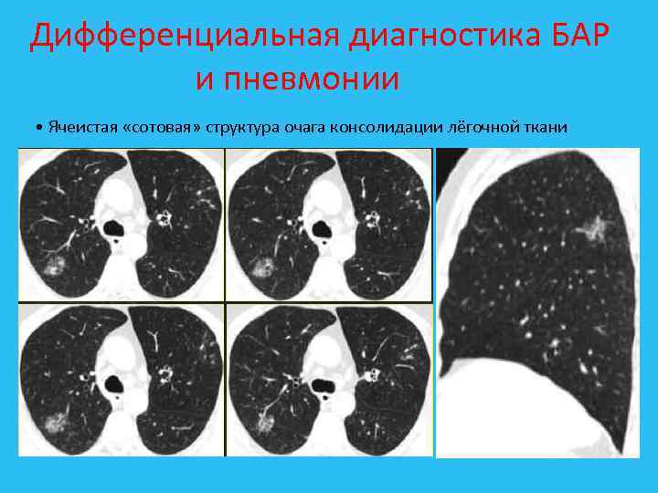 Дифференциальная диагностика БАР и пневмонии • Ячеистая «сотовая» структура очага консолидации лёгочной ткани 