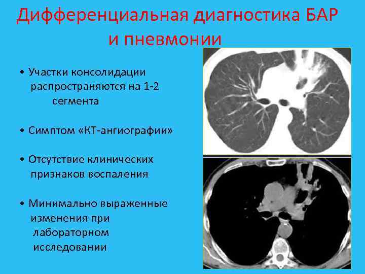 Дифференциальная диагностика БАР и пневмонии • Участки консолидации распространяются на 1 2 сегмента •