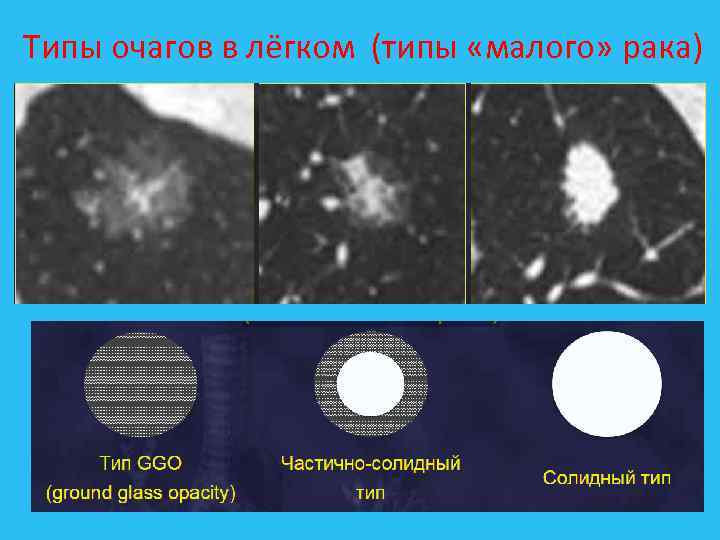  Типы очагов в лёгком (типы «малого» рака) 