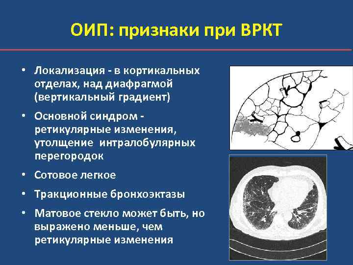 ОИП: признаки при ВРКТ • Локализация - в кортикальных отделах, над диафрагмой (вертикальный градиент)