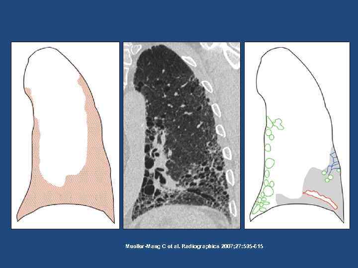 Mueller-Mang C et al. Radiographics 2007; 27: 595 -615 