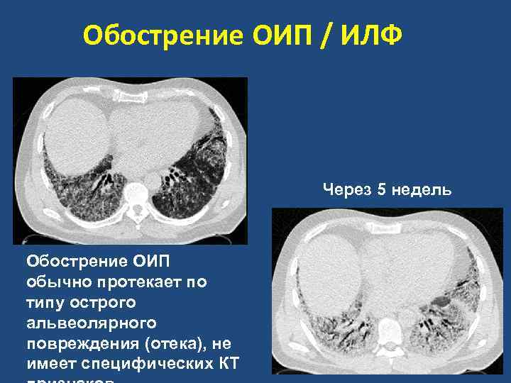 Обострение ОИП / ИЛФ Через 5 недель Обострение ОИП обычно протекает по типу острого