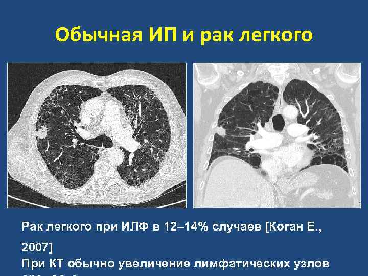 Идиопатический легочный фиброз клинические рекомендации