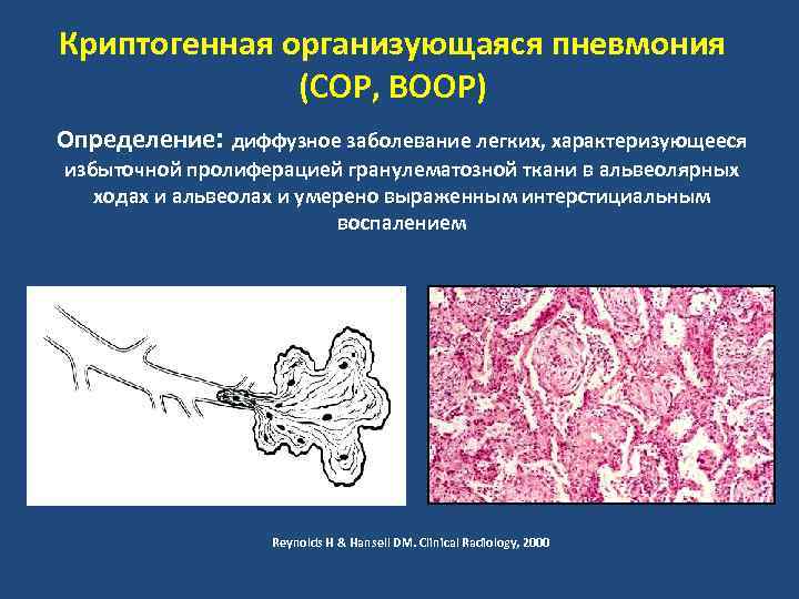 Криптогенная организующаяся пневмония (COP, BOOP) Определение: диффузное заболевание легких, характеризующееся избыточной пролиферацией гранулематозной ткани