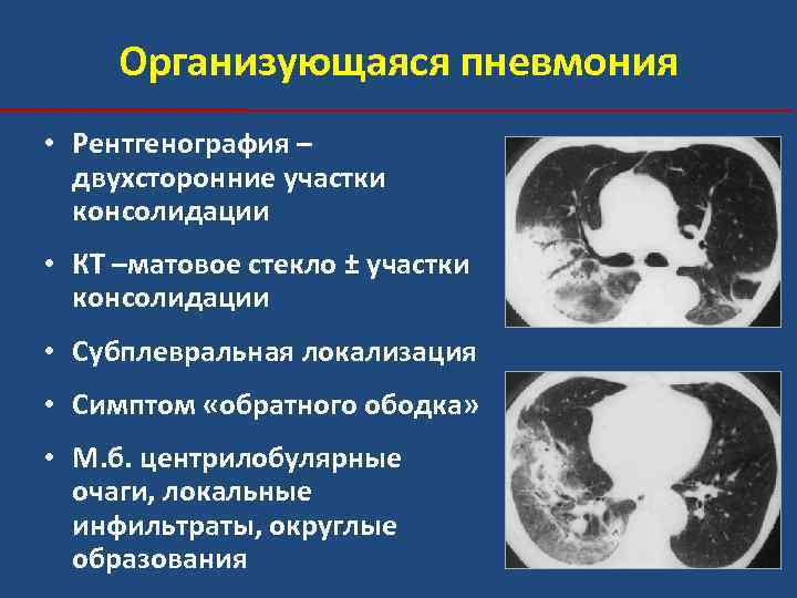 Организующаяся пневмония • Рентгенография – двухсторонние участки консолидации • КТ –матовое стекло ± участки