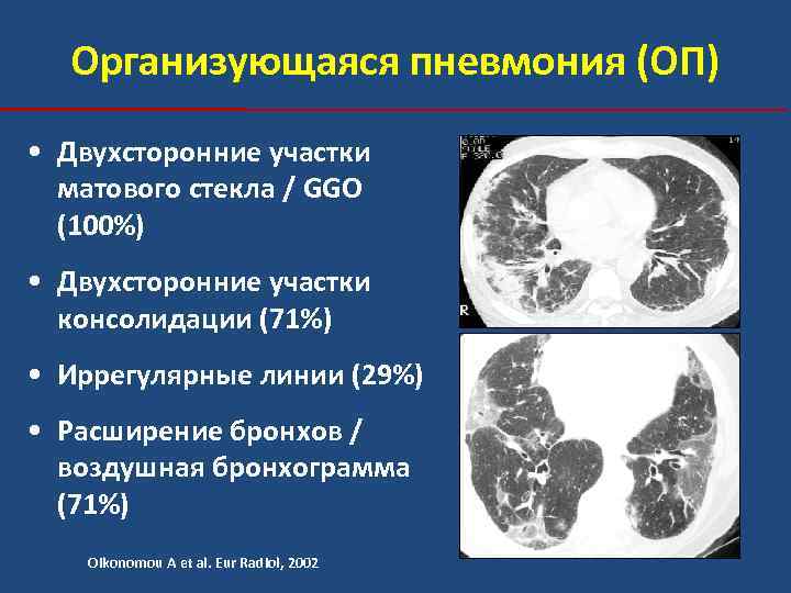 Организующаяся пневмония (ОП) • Двухсторонние участки матового стекла / GGO (100%) • Двухсторонние участки