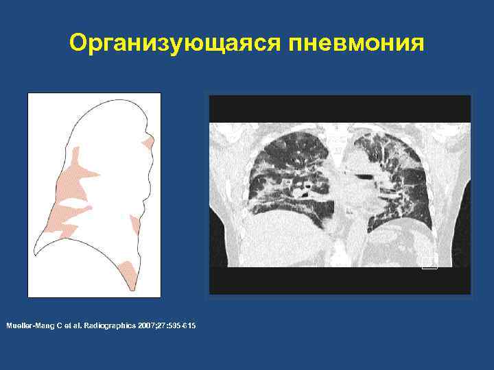 Организующаяся пневмония Mueller-Mang C et al. Radiographics 2007; 27: 595 -615 