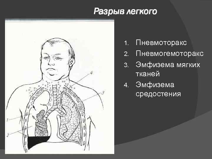 Разрыв легкого Пневмоторакс 2. Пневмогемоторакс 3. Эмфизема мягких тканей 4. Эмфизема средостения 1. 