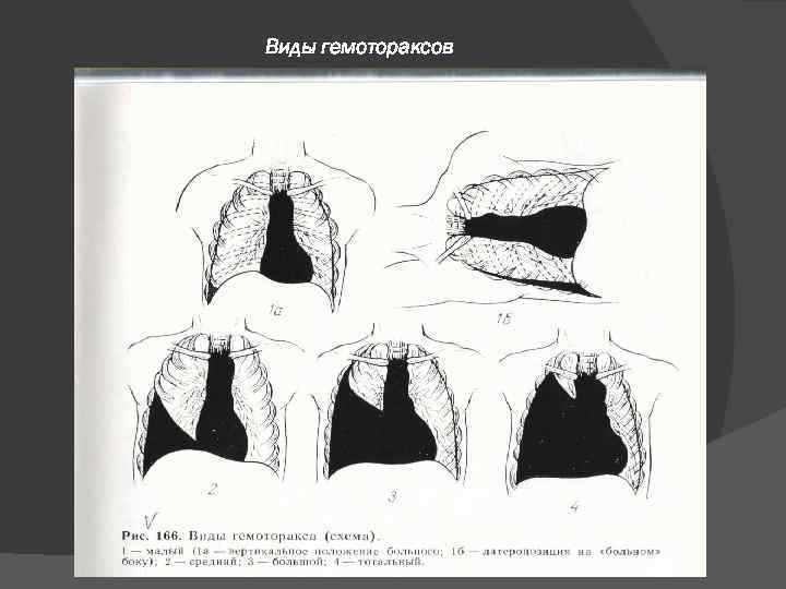 Виды гемотораксов 