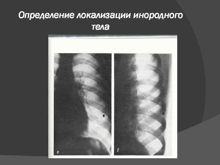 Определение локализации инородного тела 