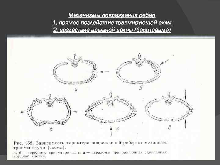 Механизмы повреждения ребер 1. прямое воздействие травмирующей силы 2. воздествие врывной волны (баротравма) 