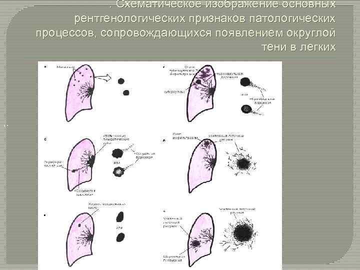 . Схематическое изображение основных рентгенологических признаков патологических процессов, cопровождающихся появлением округлой тени в легких