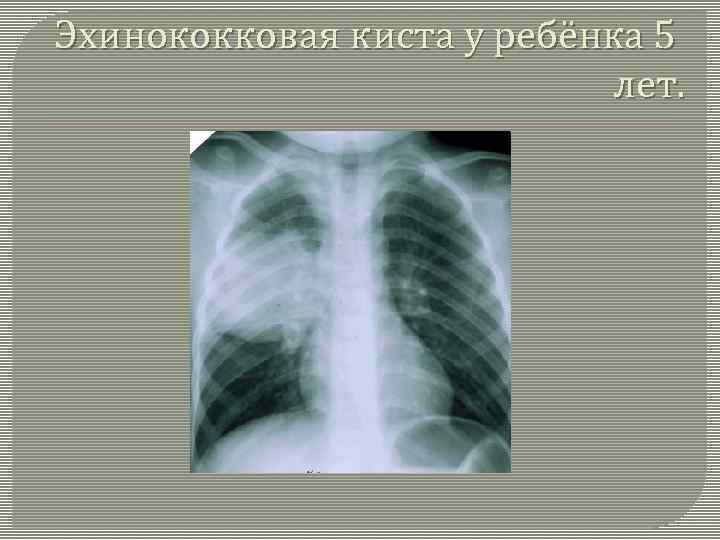 Эхинококковая киста у ребёнка 5 лет. 