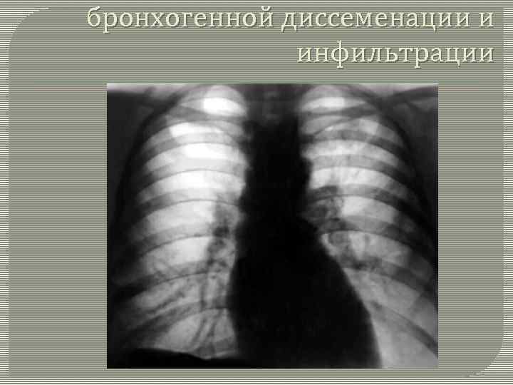 бронхогенной диссеменации и инфильтрации 