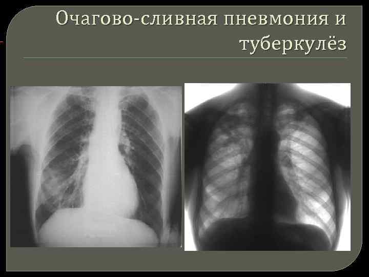  Очагово-сливная пневмония и туберкулёз 