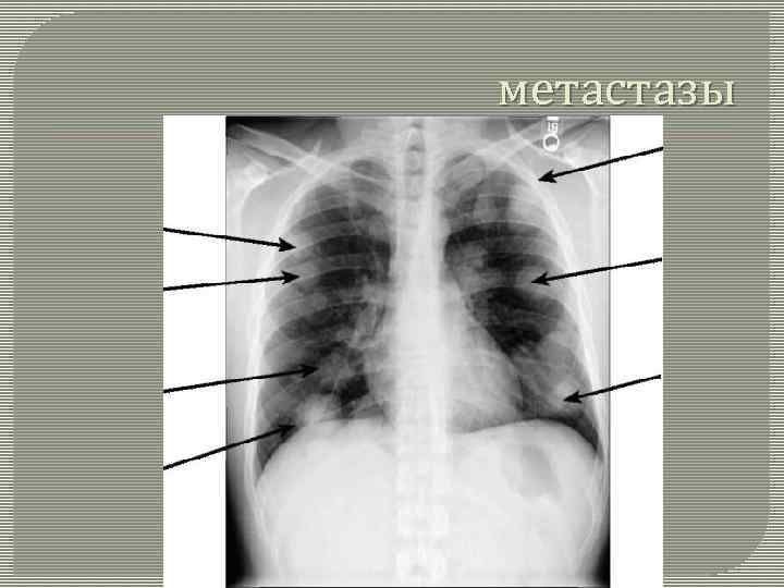 метастазы 