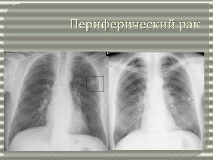 Периферический рак 