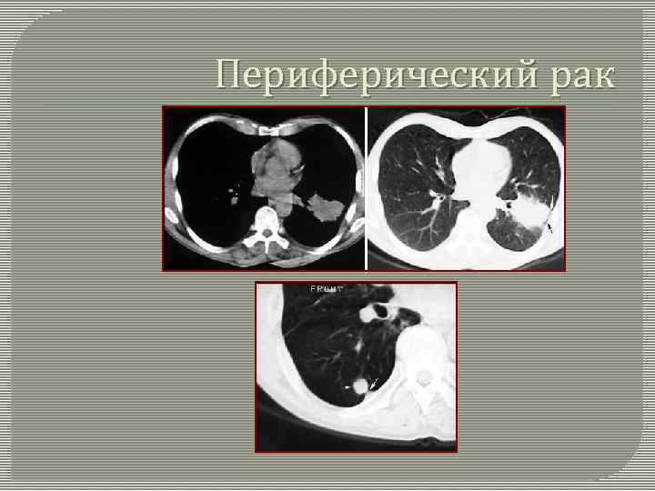 Периферический рак 