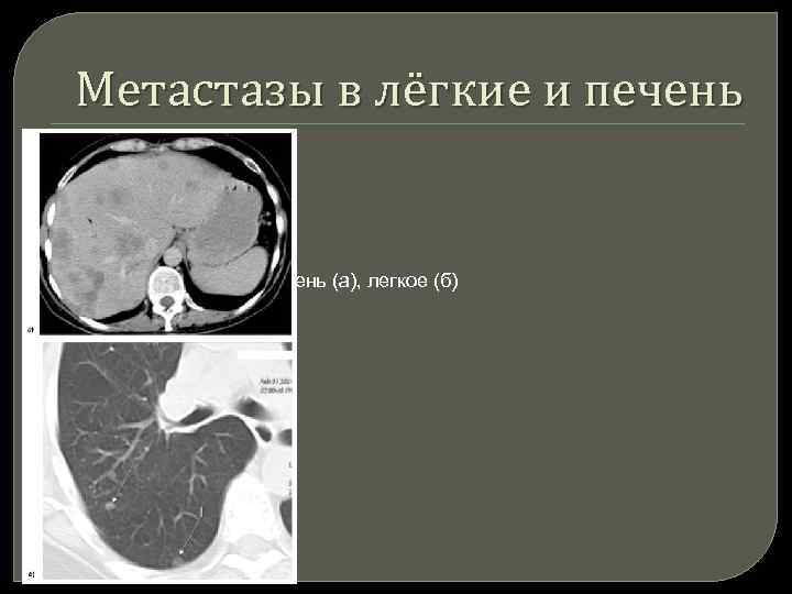 Метастазы в лёгкие и печень Рис. 12. Метастазы в печень (а), легкое (б) 