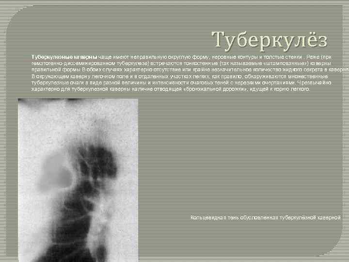 Туберкулёз Туберкулезные каверны чаще имеют неправильную округлую форму, неровные контуры и толстые стенки. Реже