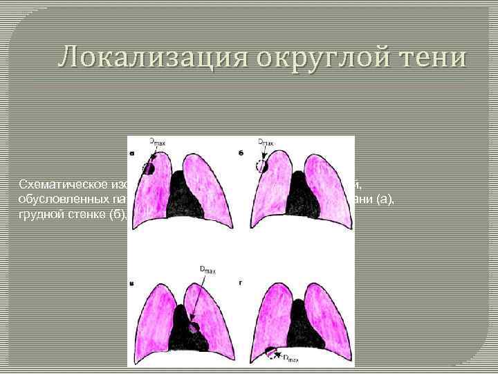 Локализация округлой тени Схематическое изображение теней округлых образований, обусловленных патологическим процессом в легочной ткани