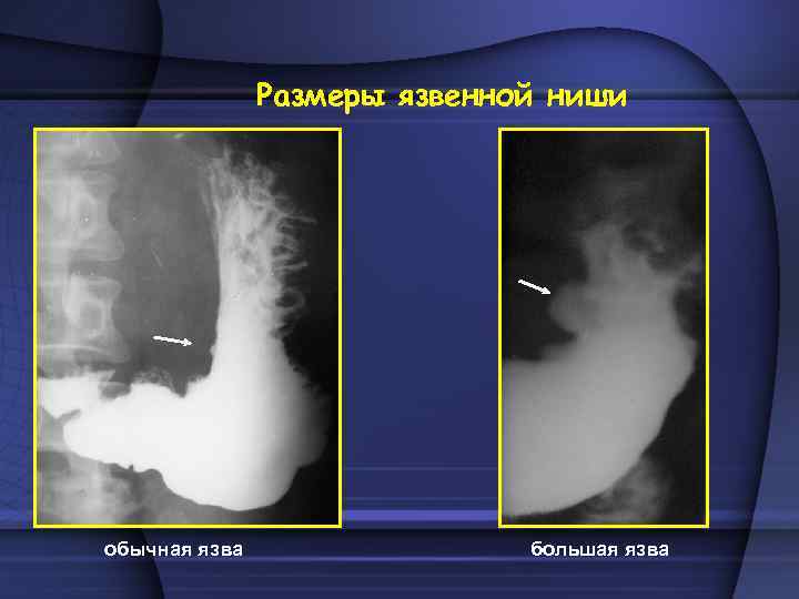 Размеры язвенной ниши обычная язва большая язва 