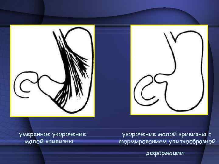 умеренное укорочение малой кривизны с формированием улиткообразной деформации 