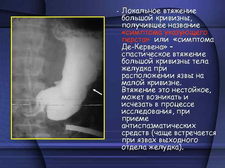 - Локальное втяжение большой кривизны, получившее название «симптома указующего перста» или «симптома Де-Кервена» –