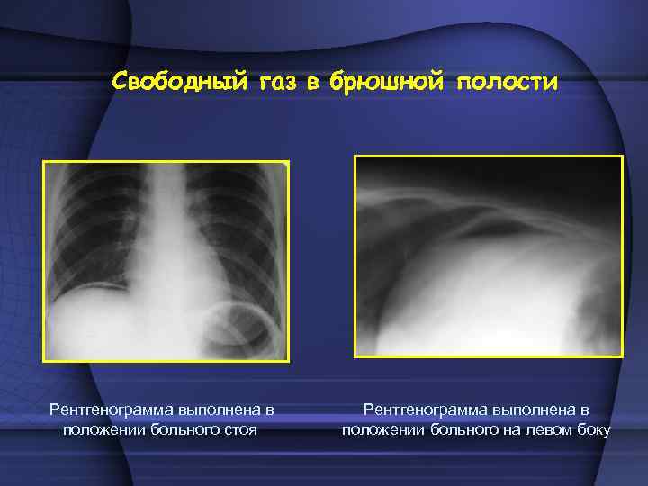 Свободный газ в брюшной полости Рентгенограмма выполнена в положении больного стоя Рентгенограмма выполнена в