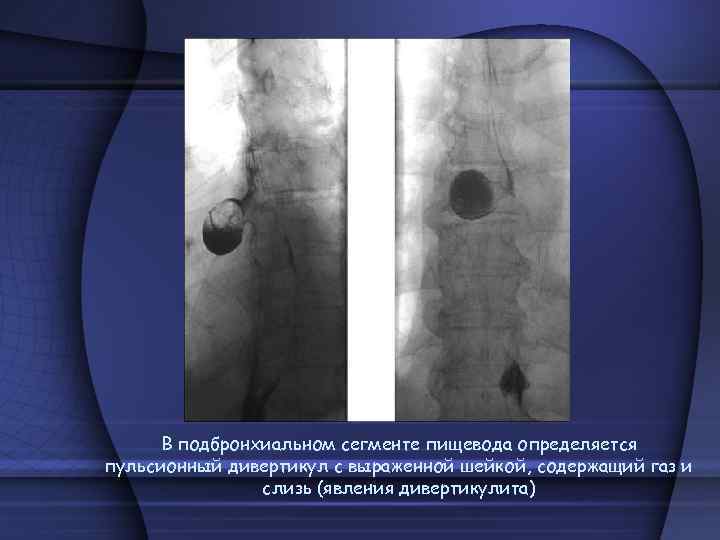 В подбронхиальном сегменте пищевода определяется пульсионный дивертикул с выраженной шейкой, содержащий газ и слизь