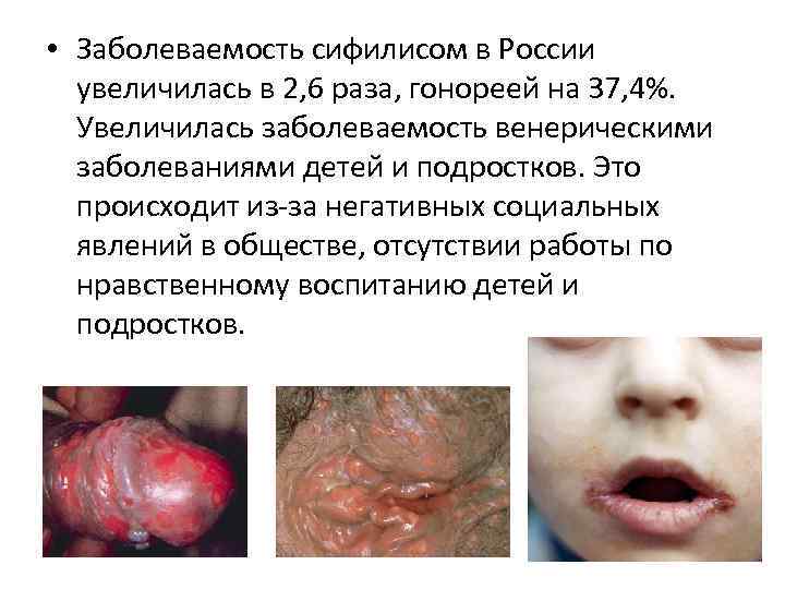  • Заболеваемость сифилисом в России увеличилась в 2, 6 раза, гонореей на 37,