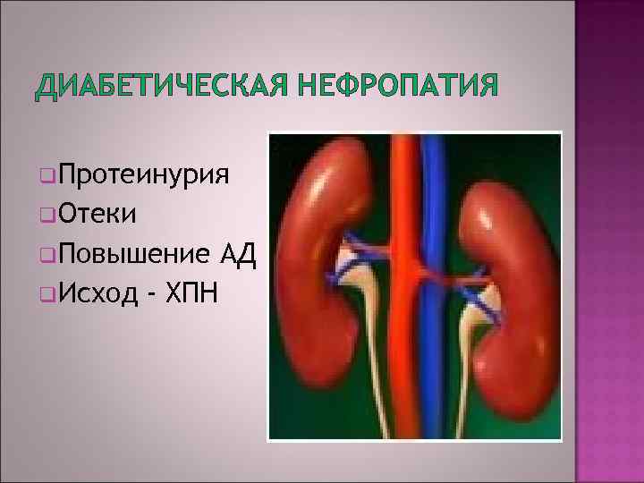 ДИАБЕТИЧЕСКАЯ НЕФРОПАТИЯ q. Протеинурия q. Отеки q. Повышение q. Исход - ХПН АД 