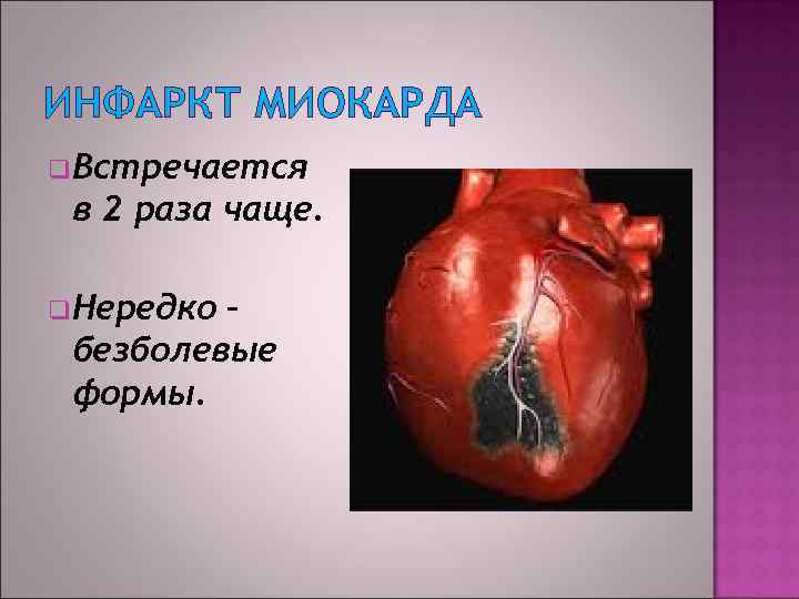 ИНФАРКТ МИОКАРДА q. Встречается в 2 раза чаще. q. Нередко – безболевые формы. 