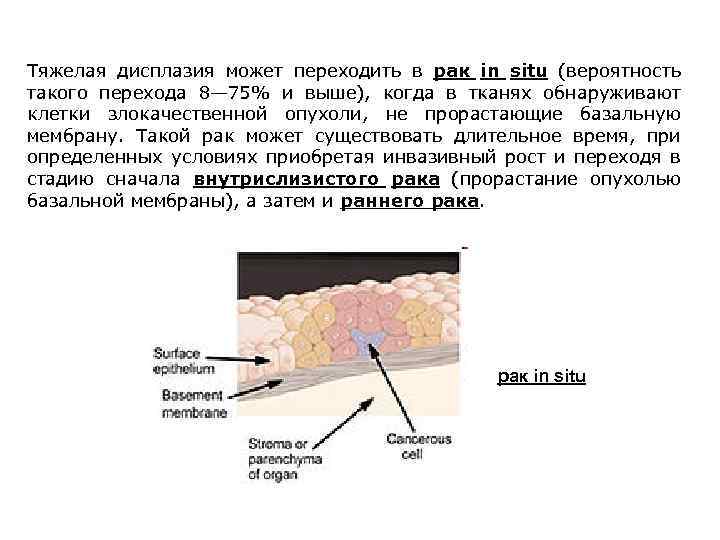 Тяжелая дисплазия может переходить в рак in situ (вероятность такого перехода 8— 75% и