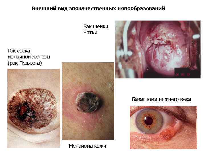 Внешний вид злокачественных новообразований Рак шейки матки Рак соска молочной железы (рак Педжета) Базалиома