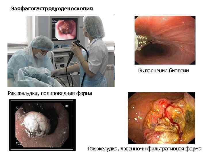Эзофагогастродуоденоскопия Выполнение биопсии Рак желудка, полиповидная форма Рак желудка, язвенно-инфильтративная форма 
