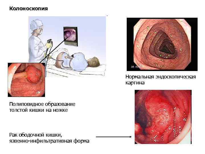 Колоноскопия Нормальная эндоскопическая картина Полиповидное образование толстой кишки на ножке Рак ободочной кишки, язвенно-инфильтративная