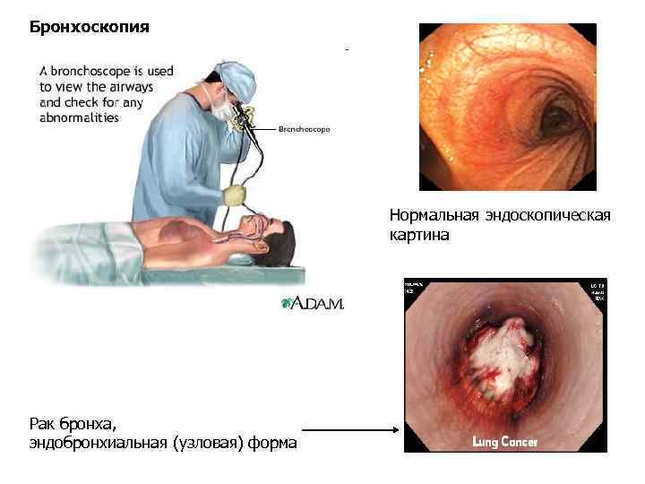 Бронхоскопия Нормальная эндоскопическая картина Рак бронха, эндобронхиальная (узловая) форма 