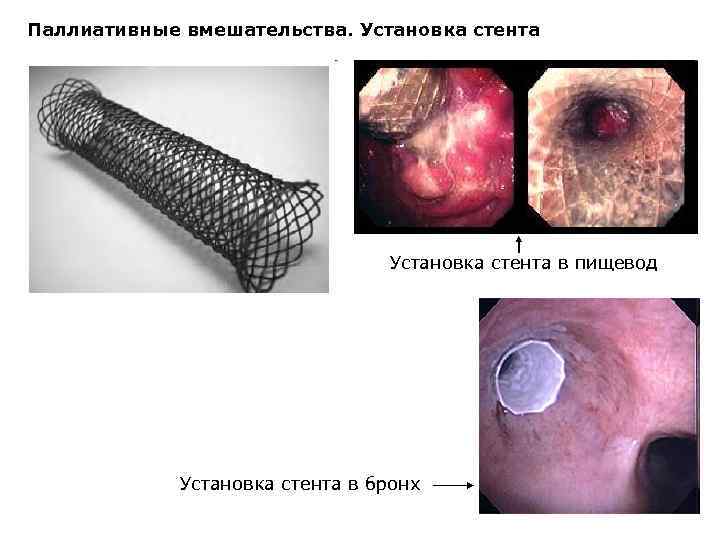 Паллиативные вмешательства. Установка стента в пищевод Установка стента в бронх 