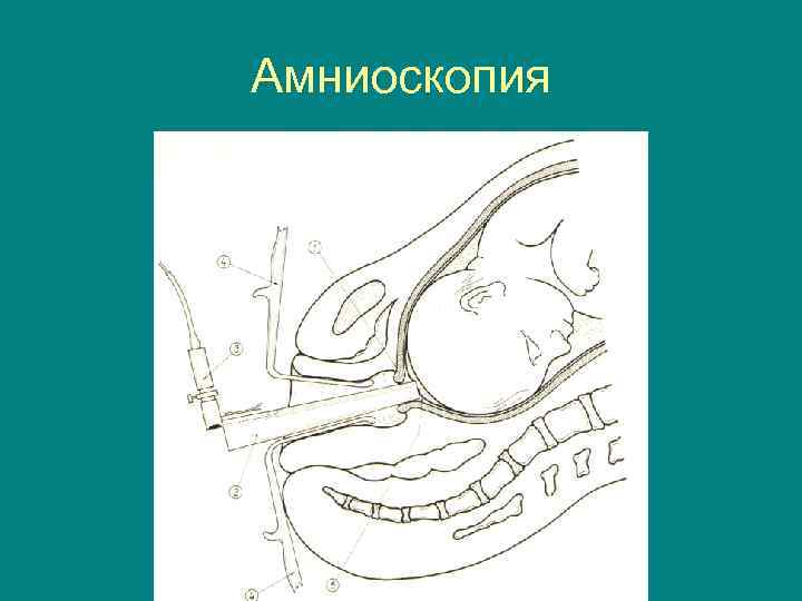 Амниоскопия 