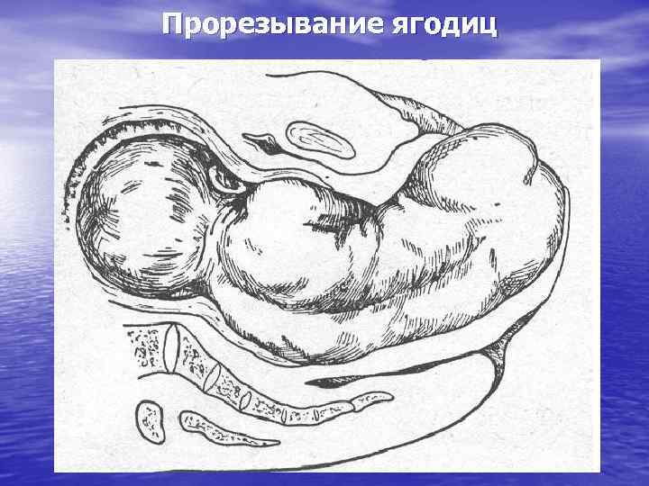 Прорезывание ягодиц 