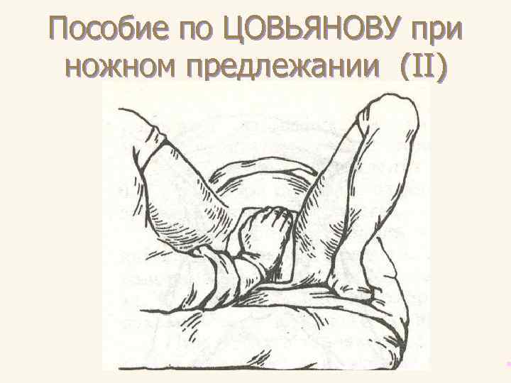 Пособие по ЦОВЬЯНОВУ при ножном предлежании (II) 