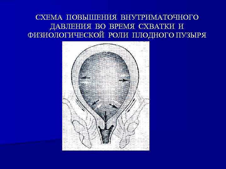 СХЕМА ПОВЫШЕНИЯ ВНУТРИМАТОЧНОГО ДАВЛЕНИЯ ВО ВРЕМЯ СХВАТКИ И ФИЗИОЛОГИЧЕСКОЙ РОЛИ ПЛОДНОГО ПУЗЫРЯ 
