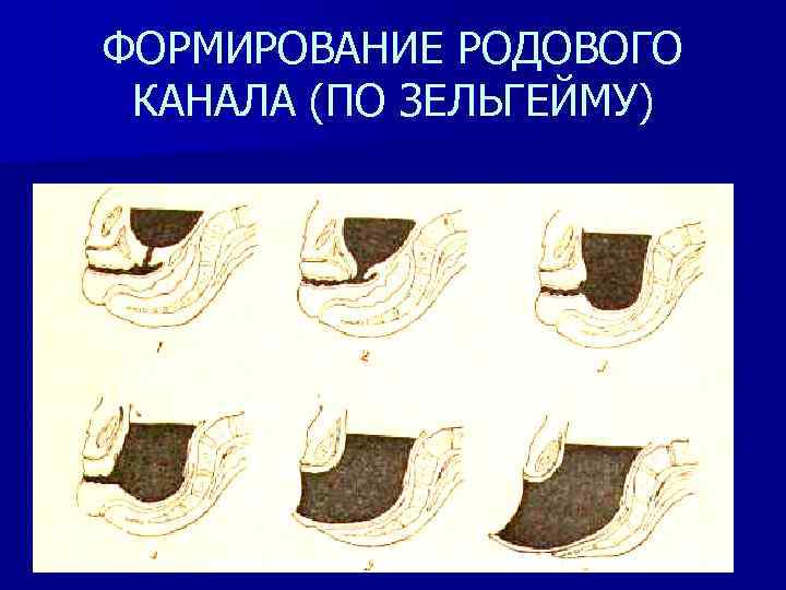 ФОРМИРОВАНИЕ РОДОВОГО КАНАЛА (ПО ЗЕЛЬГЕЙМУ) 