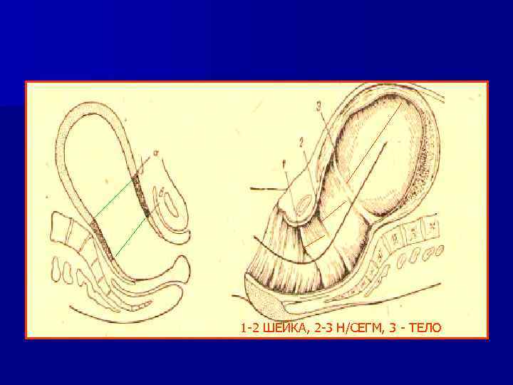 1 -2 ШЕЙКА, 2 -3 Н/СЕГМ, 3 - ТЕЛО 